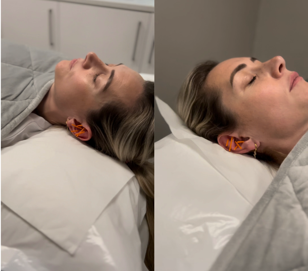 Patient lying down experiencing Weighted Tranquility Therapy with needles in both ears. Grey Weighted blanket placed over the top